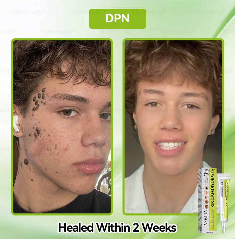 𝐺𝑙𝑖𝑚𝑚𝑒𝑟𝑙𝑦® 👩‍⚕️𝑃𝑎𝑟𝑜𝑚𝑜𝑚𝑦𝑐𝑖𝑛 & 𝑉𝑖𝑡𝑎-𝑎 𝑅𝑒𝑡𝑖𝑛𝑜𝑙 𝑆ℎ𝑜𝑡 𝑆𝑘𝑖𝑛 𝑅𝑒𝑝𝑎𝑖𝑟 𝐶𝑟𝑒𝑎𝑚（𝐖𝐢𝐭𝐡 𝐋𝐢𝐪𝐮𝐢𝐝 𝐌𝐢𝐜𝐫𝐨𝐧𝐞𝐞𝐝𝐥𝐞𝐬, 𝐆𝐞𝐧𝐭𝐥𝐲 𝐆𝐞𝐭𝐬 𝐑𝐢𝐝 𝐎𝐟 𝐖𝐚𝐫𝐭𝐬, 𝐌𝐨𝐥𝐞𝐬, 𝐀𝐠𝐞 𝐒𝐩𝐨𝐭𝐬, 𝐀𝐧𝐝 𝐒𝐤𝐢𝐧 𝐓𝐚𝐠𝐬 ）🪄