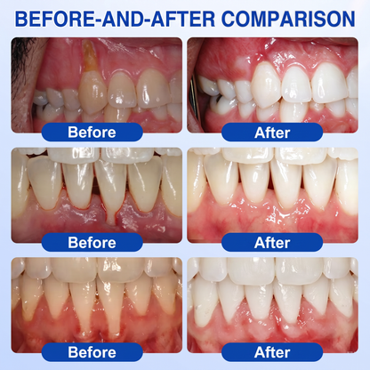 Glimmerly®🎋GumRevive periodontal repair gel🌴