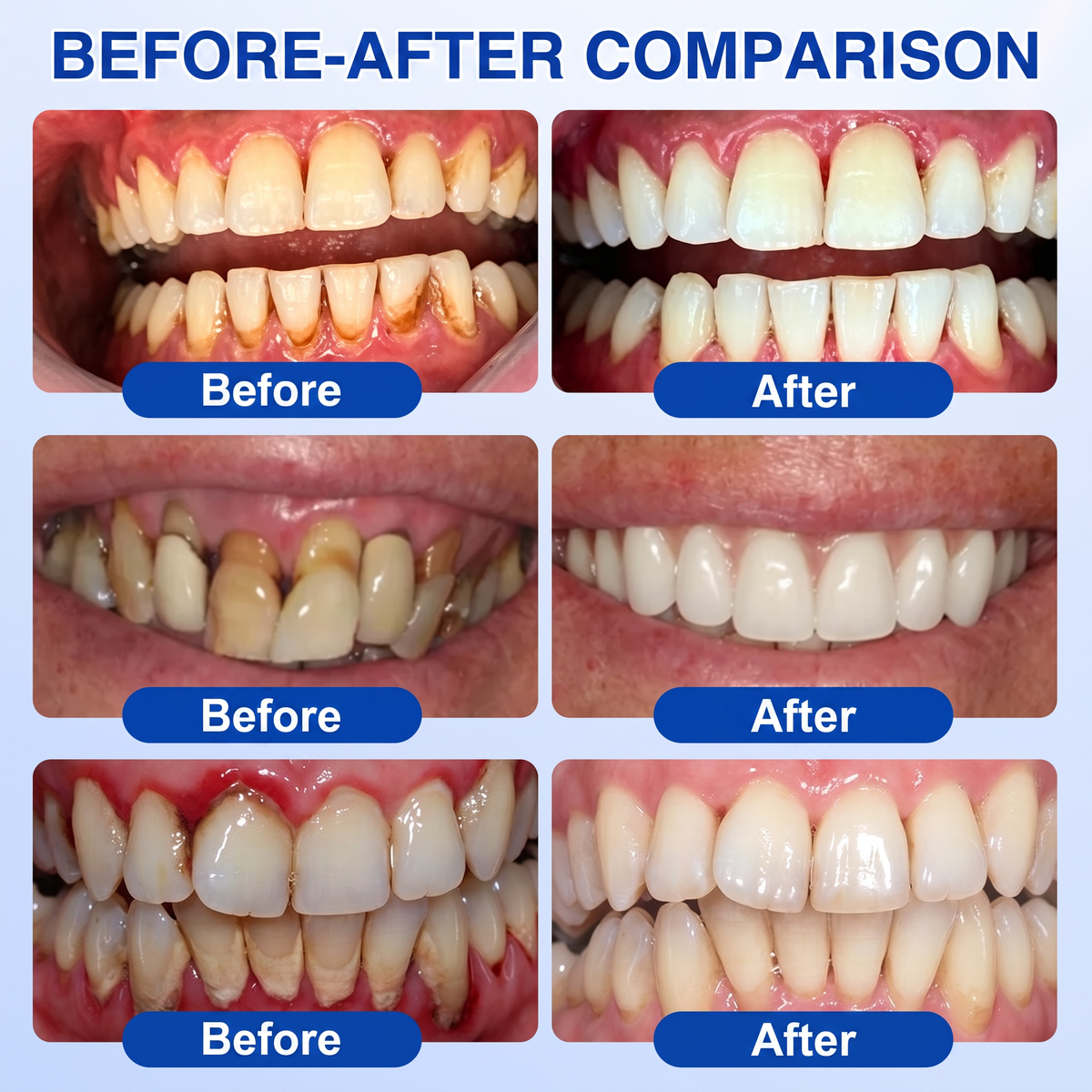 Glimmerly®🎋GumRevive periodontal repair gel🌴