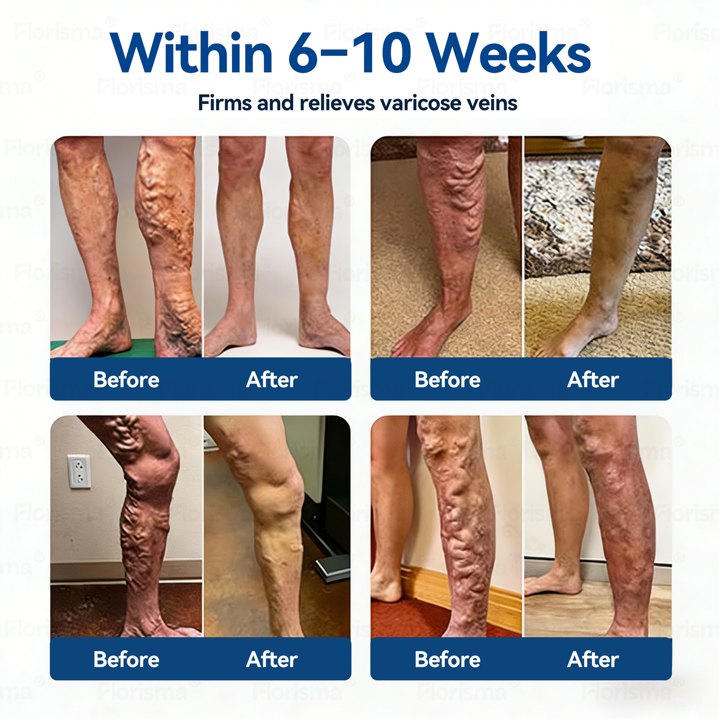One Patch a Day. Visible Vein Relief in Just 7 Days 👨‍⚕️ 𝑭𝑳𝑶𝑹𝑰𝑺𝑴𝑨® 𝑫𝑰𝑶𝑺𝑴𝑰𝑵 & 𝑯𝑬𝑺𝑷𝑬𝑹𝑰𝑫𝑰𝑵 𝑪𝒍𝒊𝒏𝒊𝒄𝒂𝒍-𝑮𝒓𝒂𝒅𝒆 𝑭𝒐𝒓𝒎𝒖𝒍𝒂 𝑴𝒊𝒄𝒓𝒐𝒏𝒆𝒆𝒅𝒍𝒆 𝑷𝒂𝒕𝒄𝒉 ⚡ 𝗔𝗱𝘃𝗮𝗻𝗰𝗲𝗱 𝗛𝗲𝗿𝗯𝗮𝗹 𝗕𝗹𝗲𝗻𝗱 𝗧𝗮𝗿𝗴𝗲𝘁𝘀 𝗦𝗽𝗶𝗱𝗲𝗿 𝗩𝗲𝗶𝗻𝘀 & 𝗥𝗲𝗹𝗶𝗲𝘃𝗲𝘀 𝗛𝗲𝗮𝘃𝘆, 𝗧𝗶𝗿𝗲𝗱 𝗟𝗲𝗴𝘀