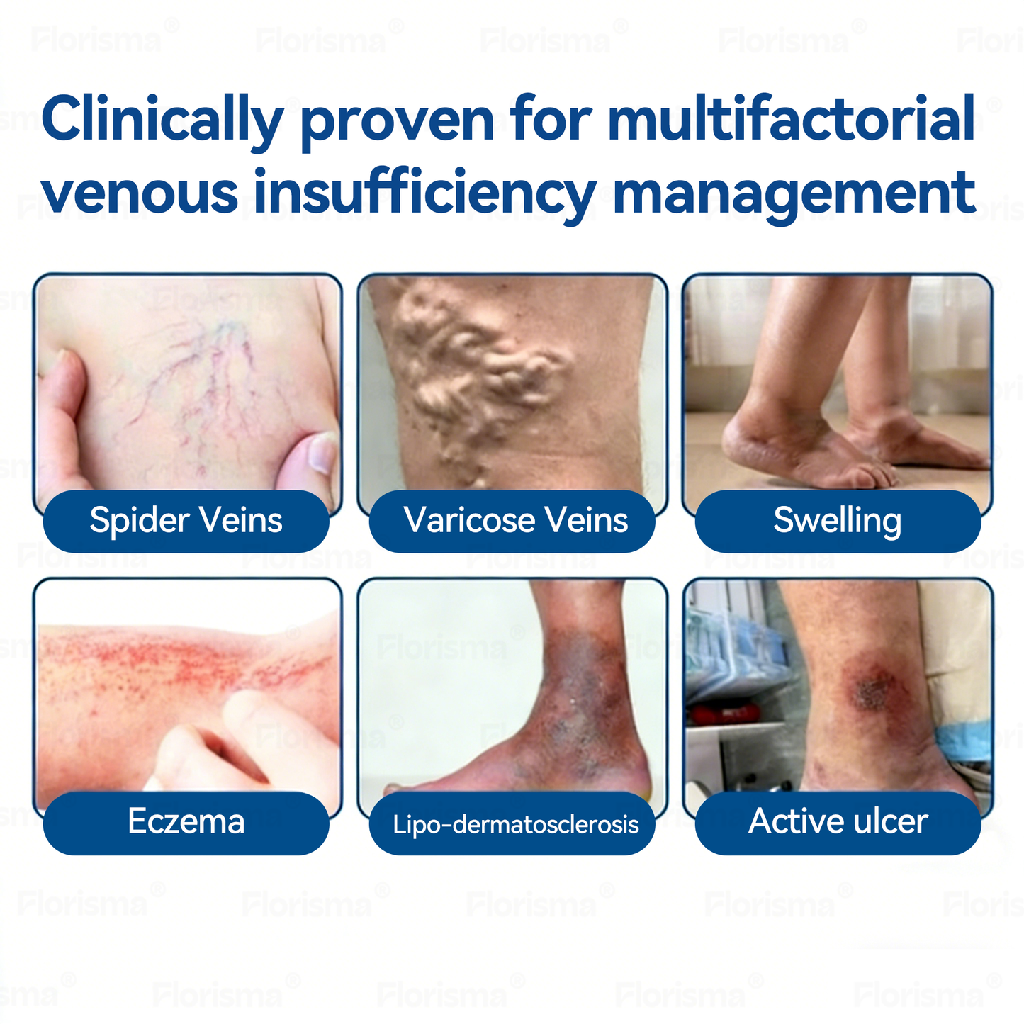One Patch a Day. Visible Vein Relief in Just 7 Days 👨‍⚕️ 𝑭𝑳𝑶𝑹𝑰𝑺𝑴𝑨® 𝑫𝑰𝑶𝑺𝑴𝑰𝑵 & 𝑯𝑬𝑺𝑷𝑬𝑹𝑰𝑫𝑰𝑵 𝑪𝒍𝒊𝒏𝒊𝒄𝒂𝒍-𝑮𝒓𝒂𝒅𝒆 𝑭𝒐𝒓𝒎𝒖𝒍𝒂 𝑴𝒊𝒄𝒓𝒐𝒏𝒆𝒆𝒅𝒍𝒆 𝑷𝒂𝒕𝒄𝒉 ⚡ 𝗔𝗱𝘃𝗮𝗻𝗰𝗲𝗱 𝗛𝗲𝗿𝗯𝗮𝗹 𝗕𝗹𝗲𝗻𝗱 𝗧𝗮𝗿𝗴𝗲𝘁𝘀 𝗦𝗽𝗶𝗱𝗲𝗿 𝗩𝗲𝗶𝗻𝘀 & 𝗥𝗲𝗹𝗶𝗲𝘃𝗲𝘀 𝗛𝗲𝗮𝘃𝘆, 𝗧𝗶𝗿𝗲𝗱 𝗟𝗲𝗴𝘀