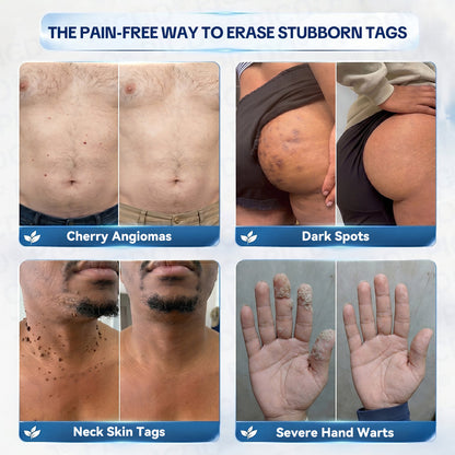𝐏𝐡𝐚𝐫𝐦𝐚𝐜𝐢𝐬𝐭 𝐑𝐞𝐜𝐨𝐦𝐦𝐞𝐧𝐝𝐞𝐝🥇𝐏𝐢𝐜𝐝𝐨® 7-𝐃𝐚𝐲 𝐒𝐤𝐢𝐧 𝐓𝐚𝐠 & 𝐒𝐩𝐨𝐭 𝐄𝐫𝐚𝐬𝐞𝐫 𝐂𝐫𝐞𝐚𝐦 🌻(Zero Pain, Zero 𝐒𝐜𝐚𝐫𝐬 Formula)