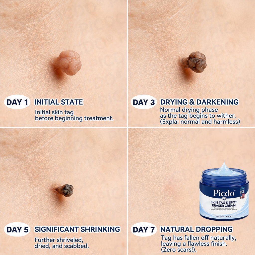 𝐏𝐡𝐚𝐫𝐦𝐚𝐜𝐢𝐬𝐭 𝐑𝐞𝐜𝐨𝐦𝐦𝐞𝐧𝐝𝐞𝐝🥇𝐏𝐢𝐜𝐝𝐨® 7-𝐃𝐚𝐲 𝐒𝐤𝐢𝐧 𝐓𝐚𝐠 & 𝐒𝐩𝐨𝐭 𝐄𝐫𝐚𝐬𝐞𝐫 𝐂𝐫𝐞𝐚𝐦 🌻(Zero Pain, Zero 𝐒𝐜𝐚𝐫𝐬 Formula)