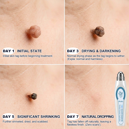 𝐏i𝐜𝐝o®7-𝐷𝑎𝑦 𝗧𝐚𝐠 & 𝗦𝗽𝐨𝐭 𝐄𝐫𝒂𝒔𝒆𝒓(Zero Pain, Zero 𝐒𝐜𝐚𝒓𝒔 Rollerball)🍀